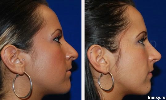 cirugia plastica nariz Rinoplastia