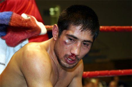 Боксерские травмы (13 Фото)