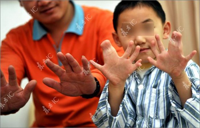 Мальчик с 34 пальцами (13 фото)