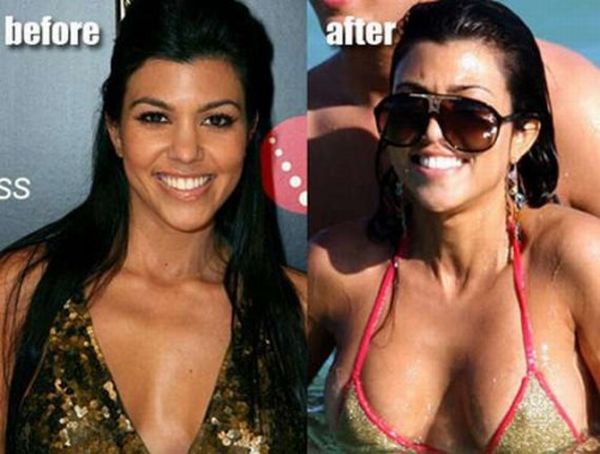 Звезды до и после операций по увеличению груди (10 фото)