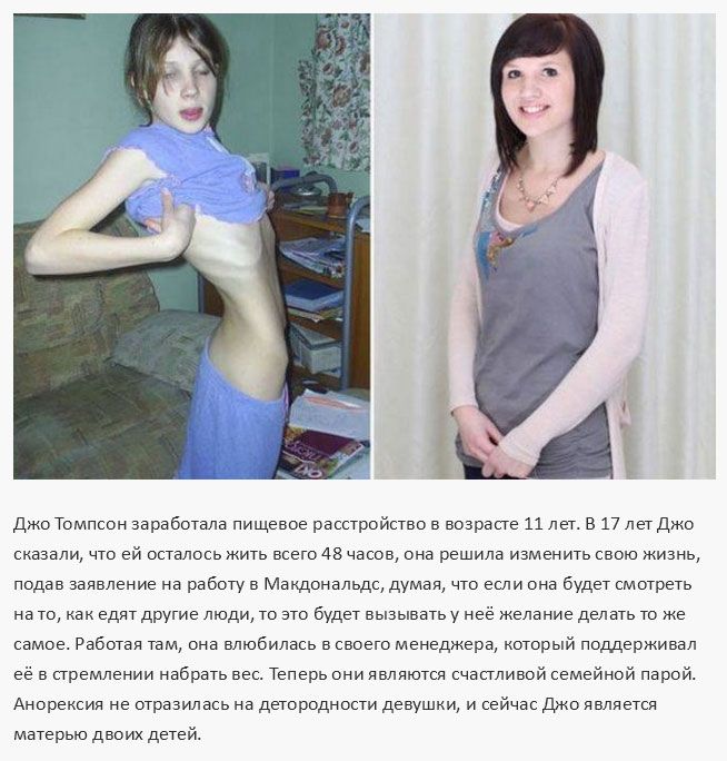 Люди, победившие анорексию (15 фото)
