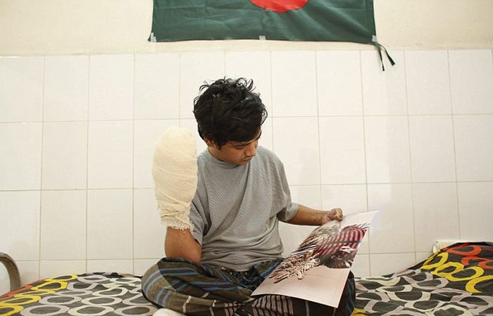 «Человек-дерево» из Бангладеш перенес 16 операций по удалению наростов на конечностях (6 фото)